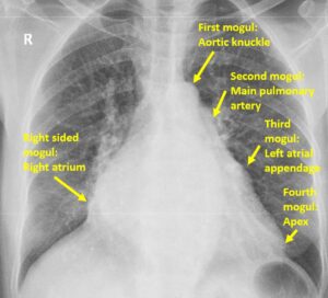 Mogul signs on chest X-ray – All About Cardiovascular System and Disorders