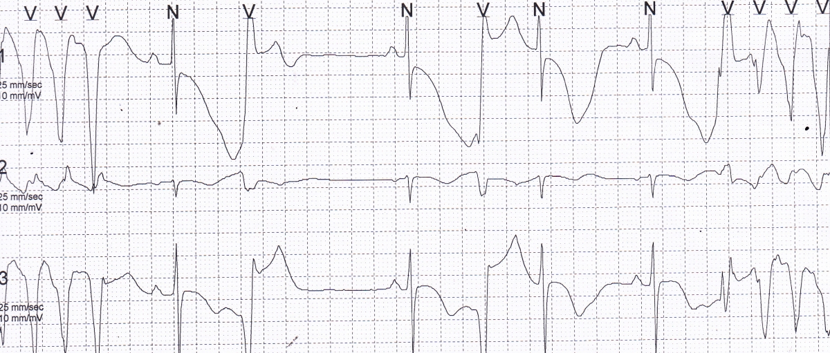 Giant T inversion with NSVT