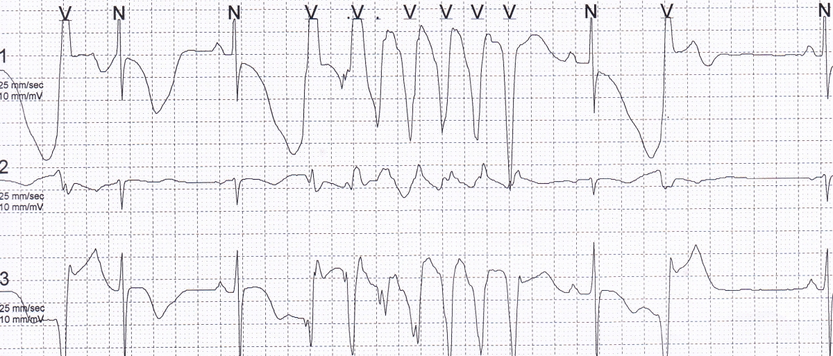 Giant T inversion with polymorphic NSVT