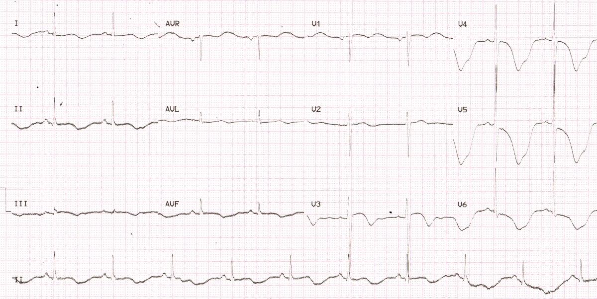 Giant T inversion with QT prolongation