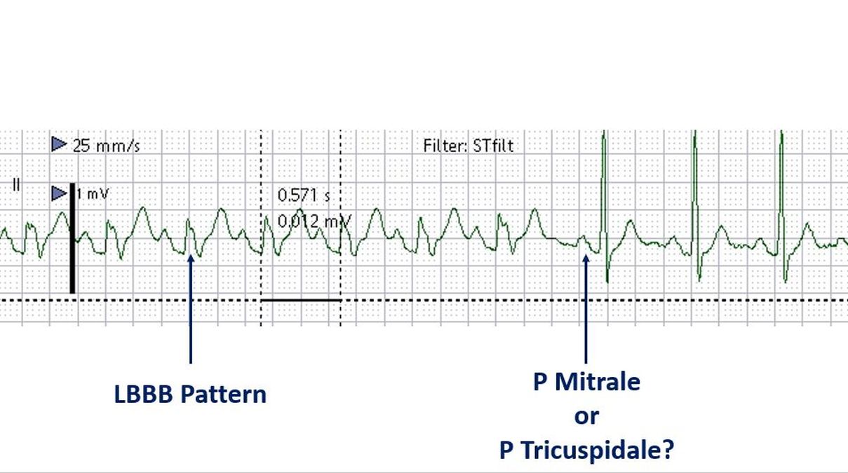 Intermittent LBBB and P Mitrale or Tricuspidale