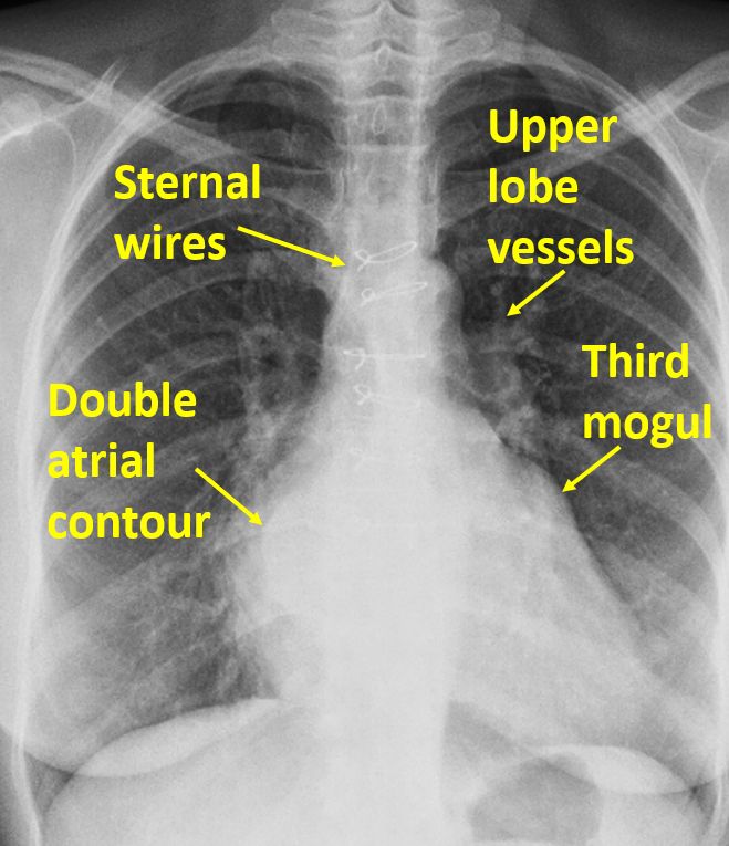 Post mitral annuloplasty CXR