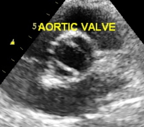 Bicuspid aortic valve in open positionBicuspid aortic valve in open position