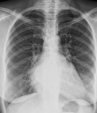 Chest X-ray after mitral annuloplasty