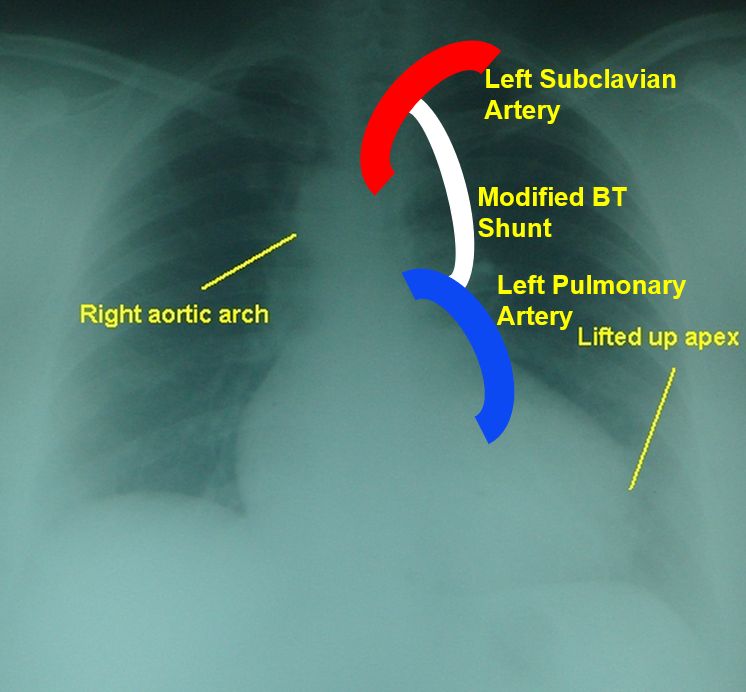 Schematic diagram of a modified Blalock-Taussig shunt in a person with right aortic arch and tetralogy of Fallot