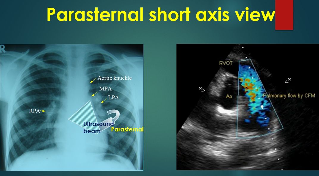 Parasternal short axis view aorta pulmonary artery