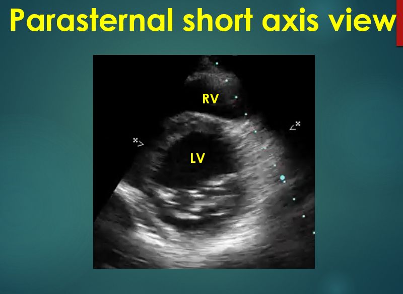 Parasternal short axis view of left ventricle