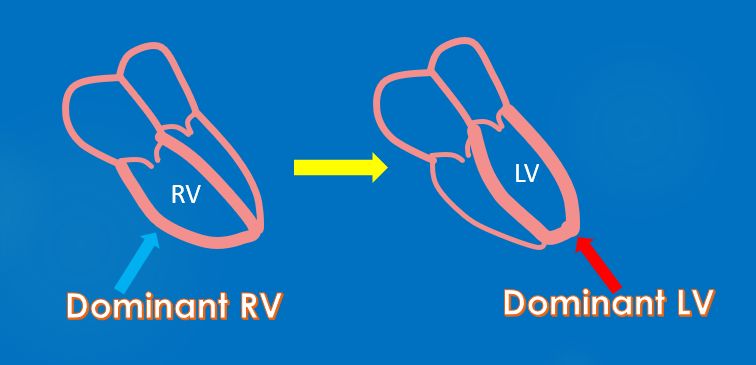 Regression of right ventricle