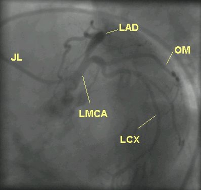 Left coronary angiogram in LAO caudal view