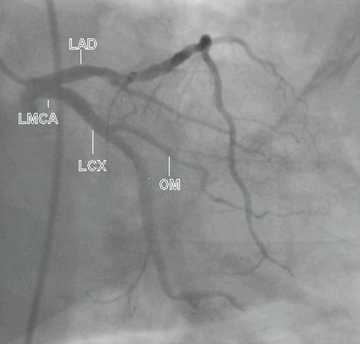 Left coronary angiogram in RAO caudal view