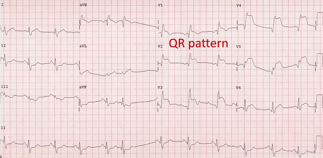 Anterior wall infarction with RBBB