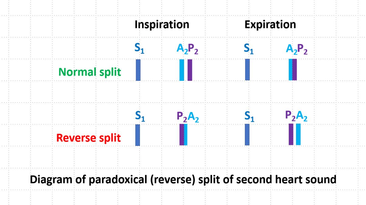 Paradoxical split of second heart sound