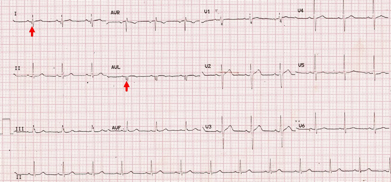 High lateral wall infarction