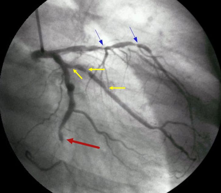 Left coronary angiogram