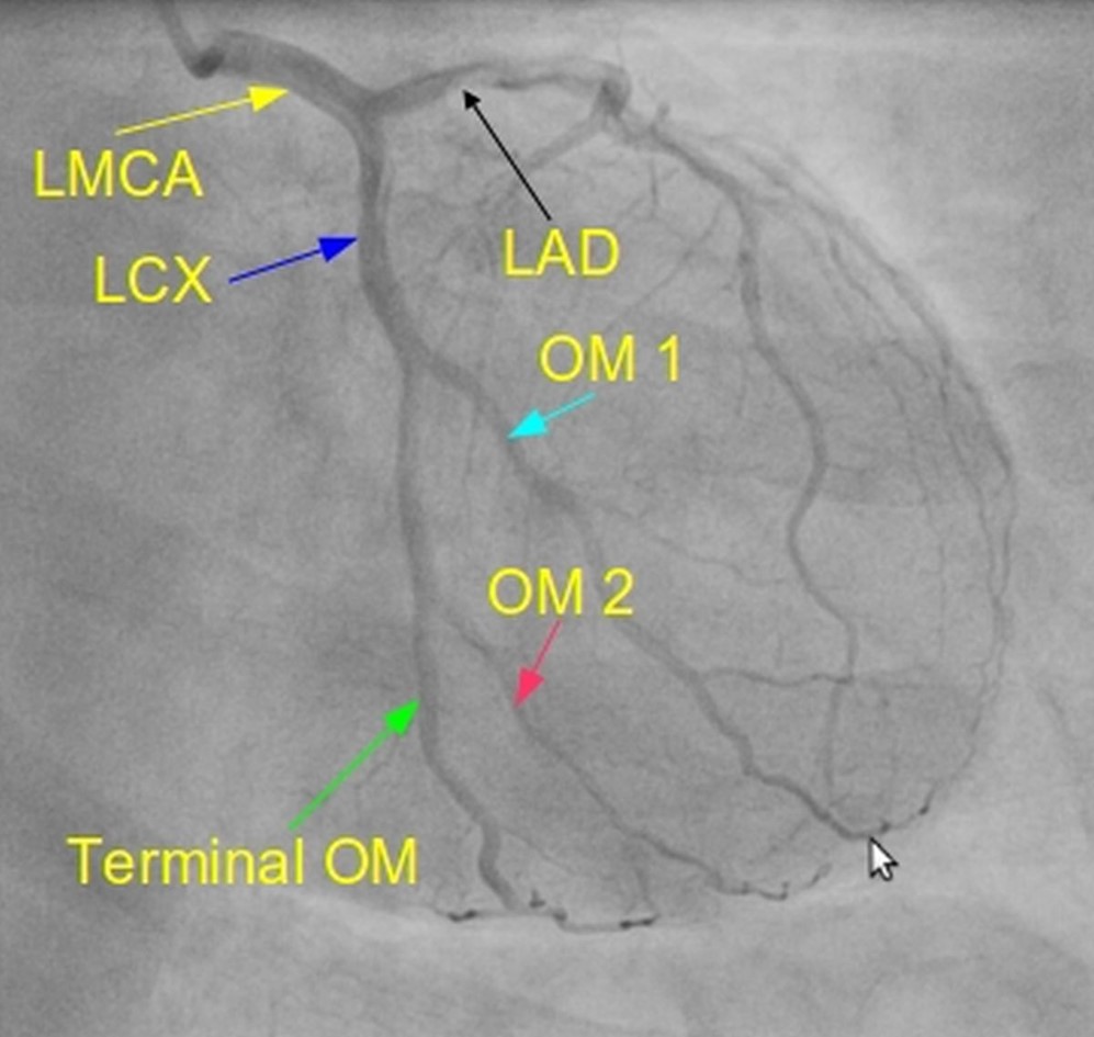 Non dominant left coronary artery