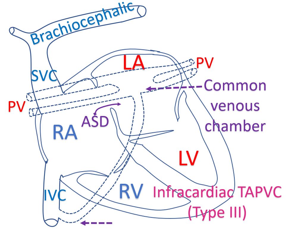 Infracardiac TAPVC (Type III)