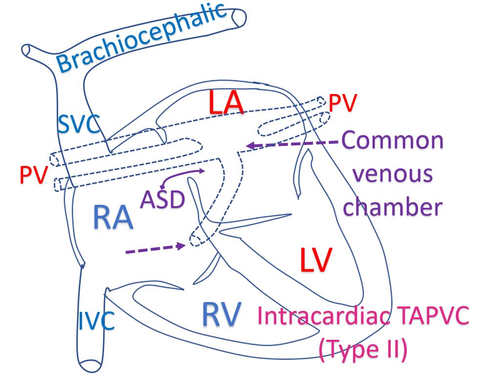 Intracardiac TAPVC (Type II)