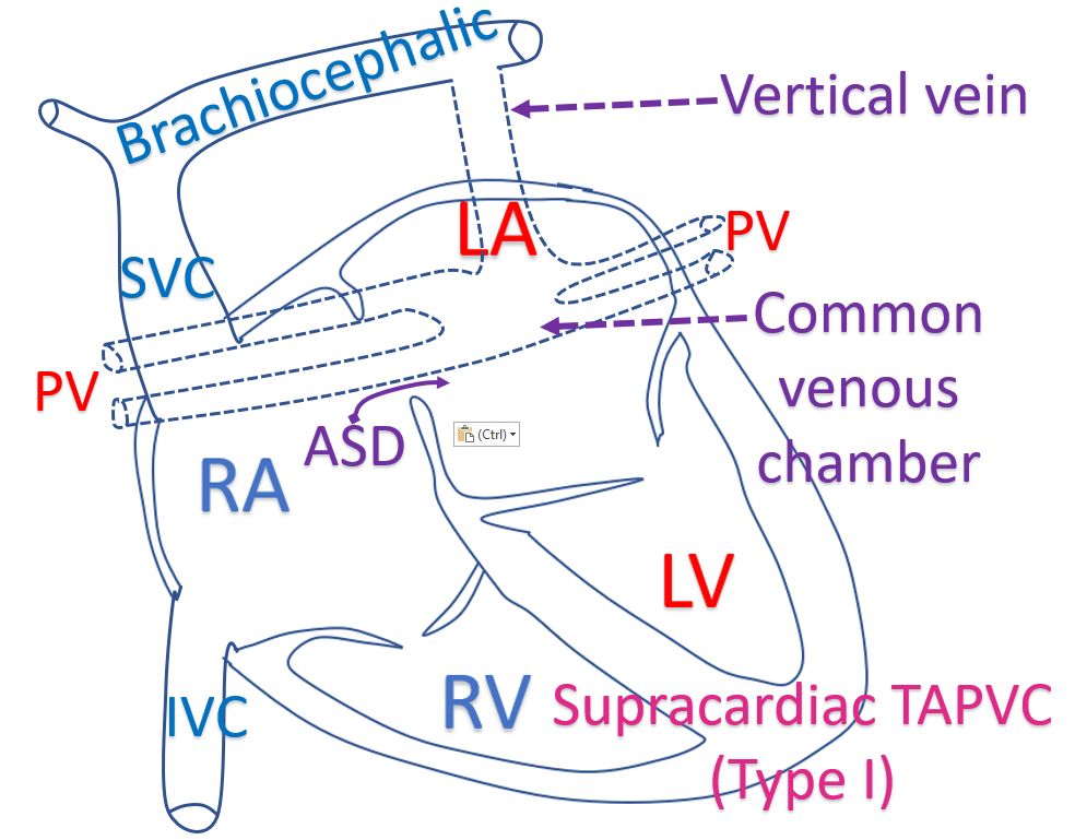 Supracardiac TAPVC (Type I)