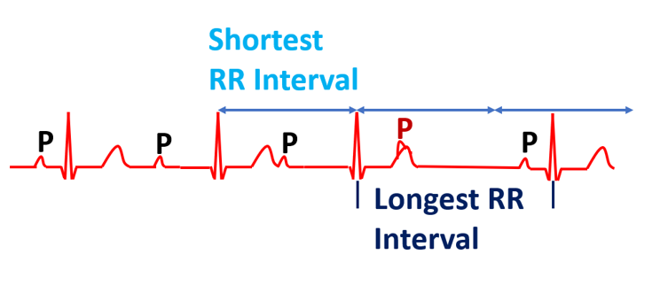 Features of Wenckebach Phenomenon - Shortest and Longest RR Interval