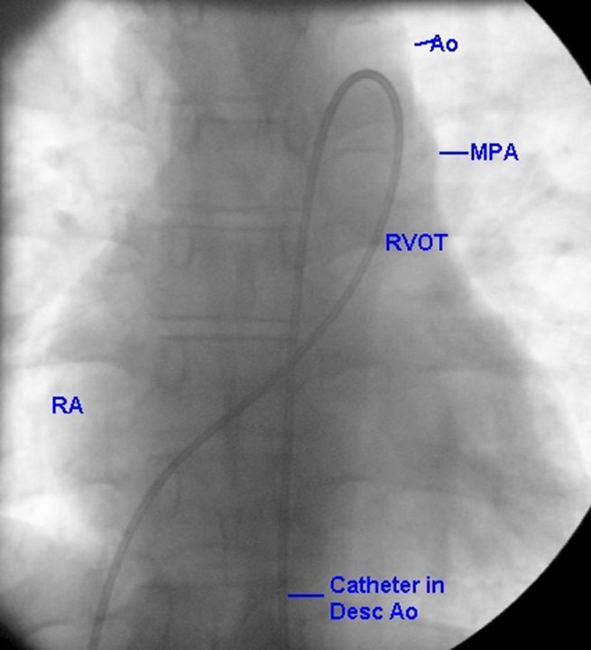 Cournand Catheter Fluoroscopic View