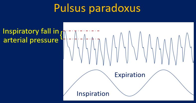 Pulsus paradoxus - arterial pressure tracing