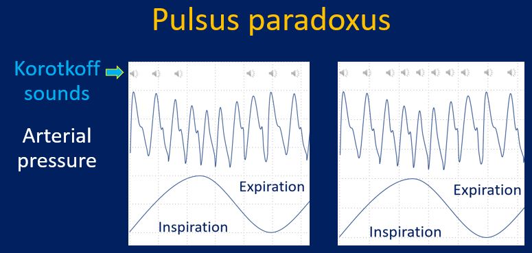 Pulsus paradoxus - clinical documentation