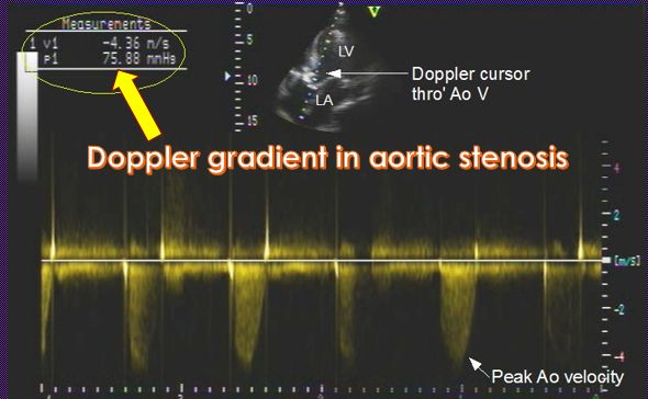 Doppler peak instantaneous gradient in aortic stenosis