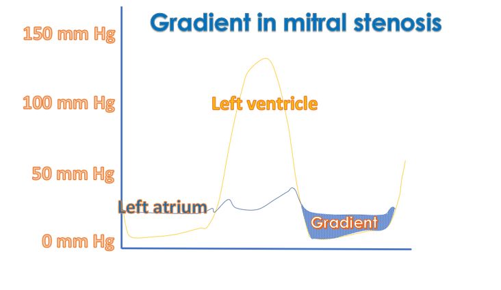 Mean gradient in mitral stenosis