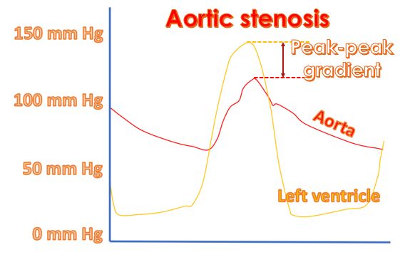 Simultaneous left ventricular and aortic pressure tracings in valvar aortic stenosis