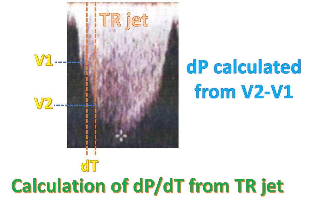Calculation of dP by dT from TR jet