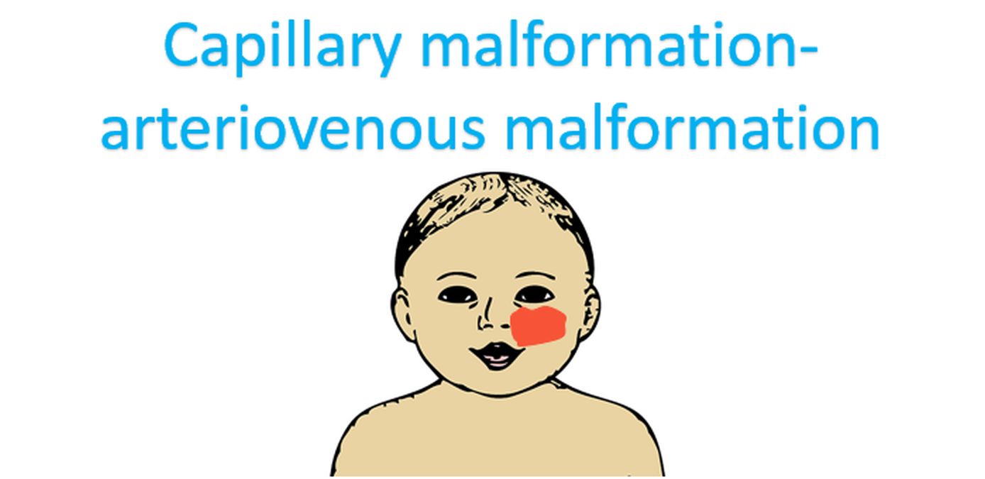 Capillary malformation-arteriovenous malformation (Representative image)