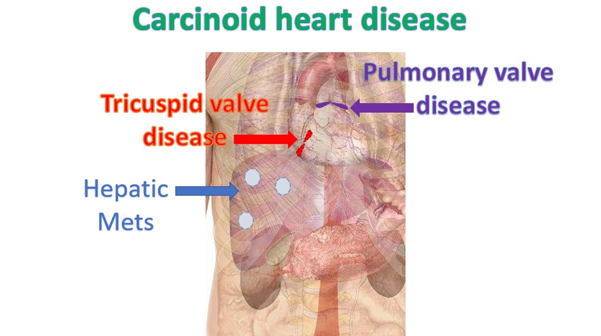 Carcinoid heart disease