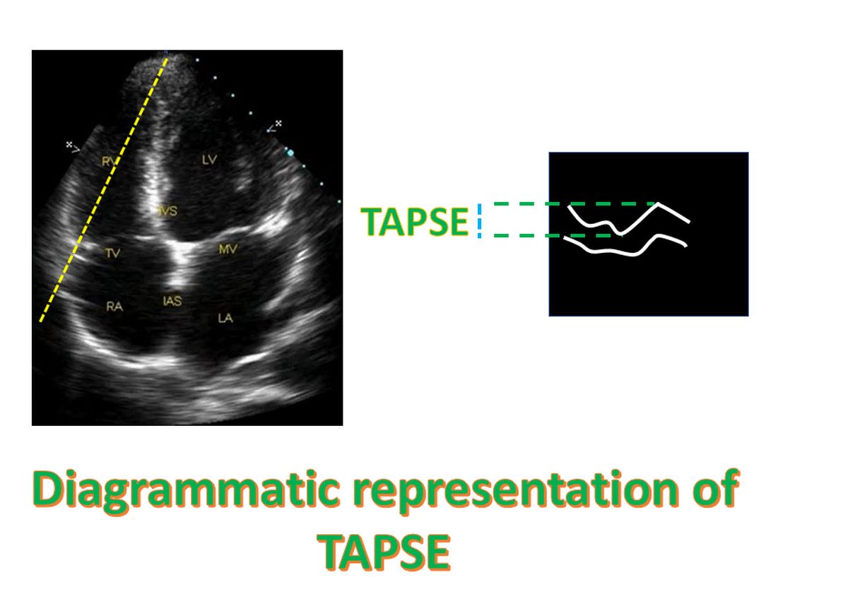 Diagrammatic representation of TAPSE