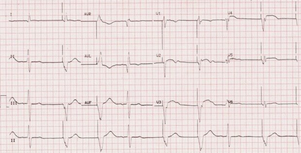 Paced rhythm with very wide QRS – All About Cardiovascular System and ...