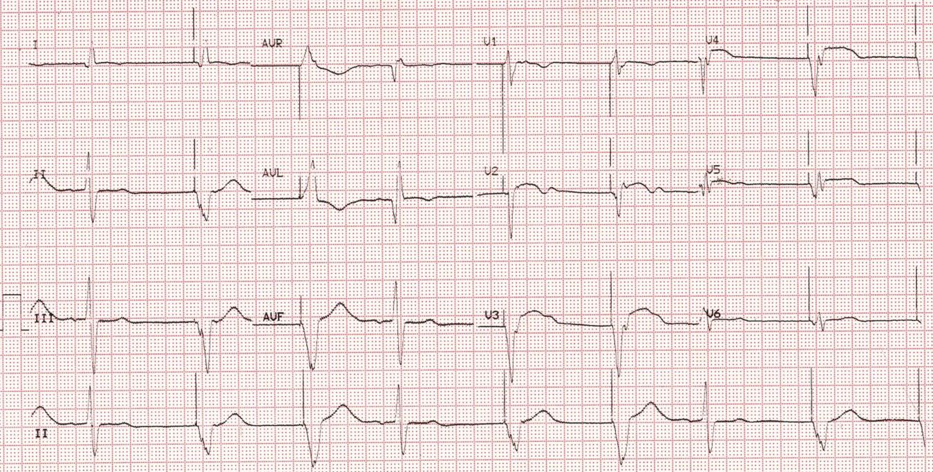 Paced rhythm with very wide QRS