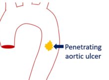 Penetrating aortic ulcer