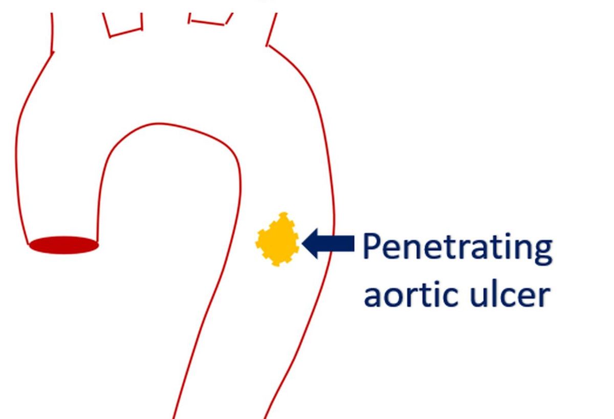 Penetrating aortic ulcer