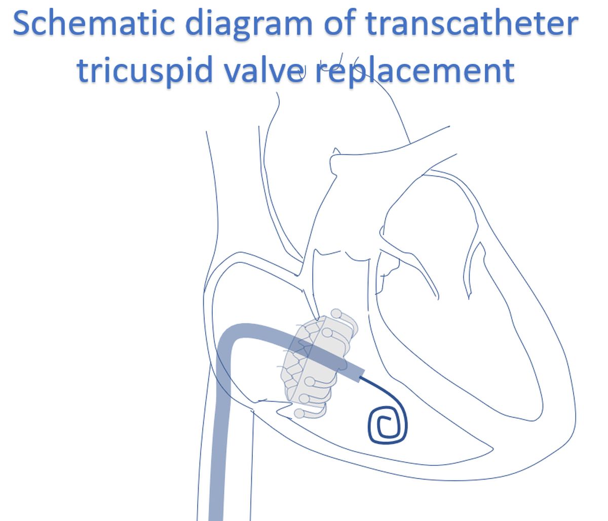 Schematic diagram of transcatheter tricuspid valve replacement