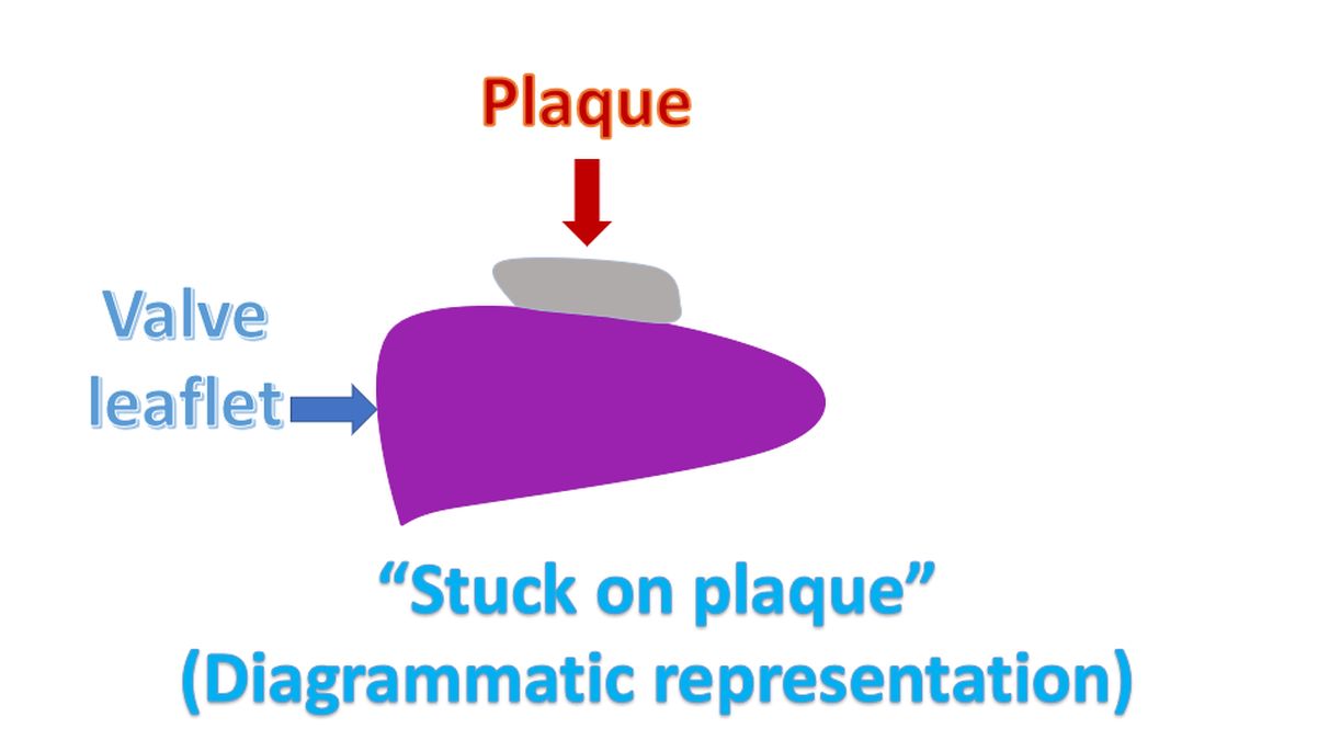 “Stuck on plaque” (Diagrammatic representation)
