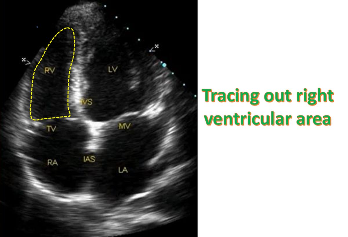 Tracing out right ventricular area