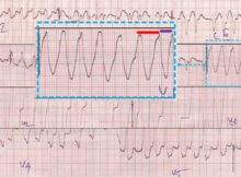 AF with WPW syndrome - variation in RR intervals