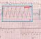 AF with WPW syndrome - variation in RR intervals