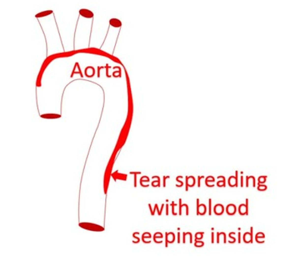 Aortic dissection