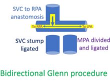 Bidirectional Glenn procedure - schematic diagram
