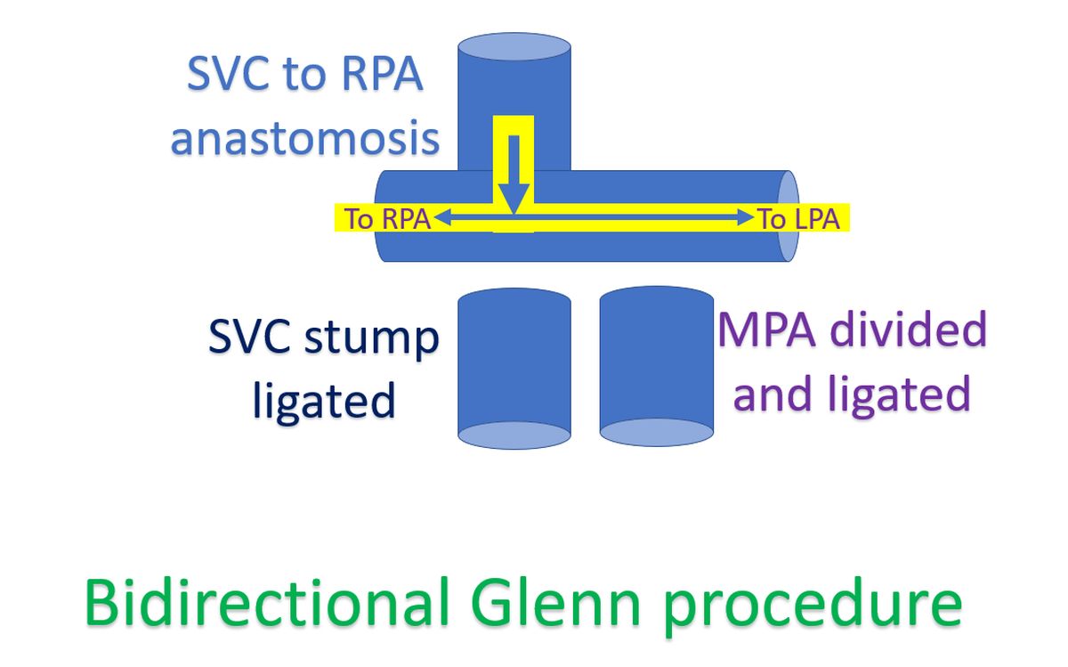 Bidirectional Glenn procedure - schematic diagram