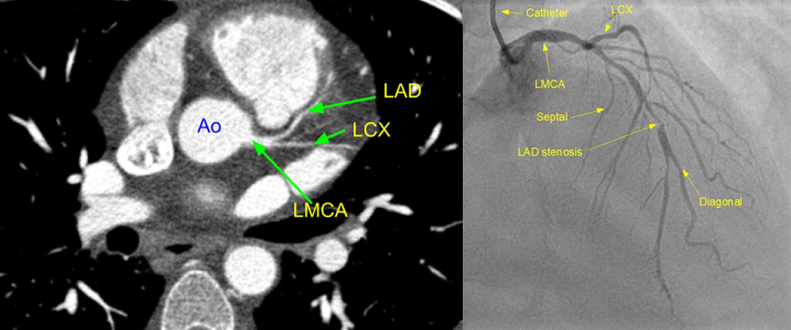 CT vs invasive coronary angiography