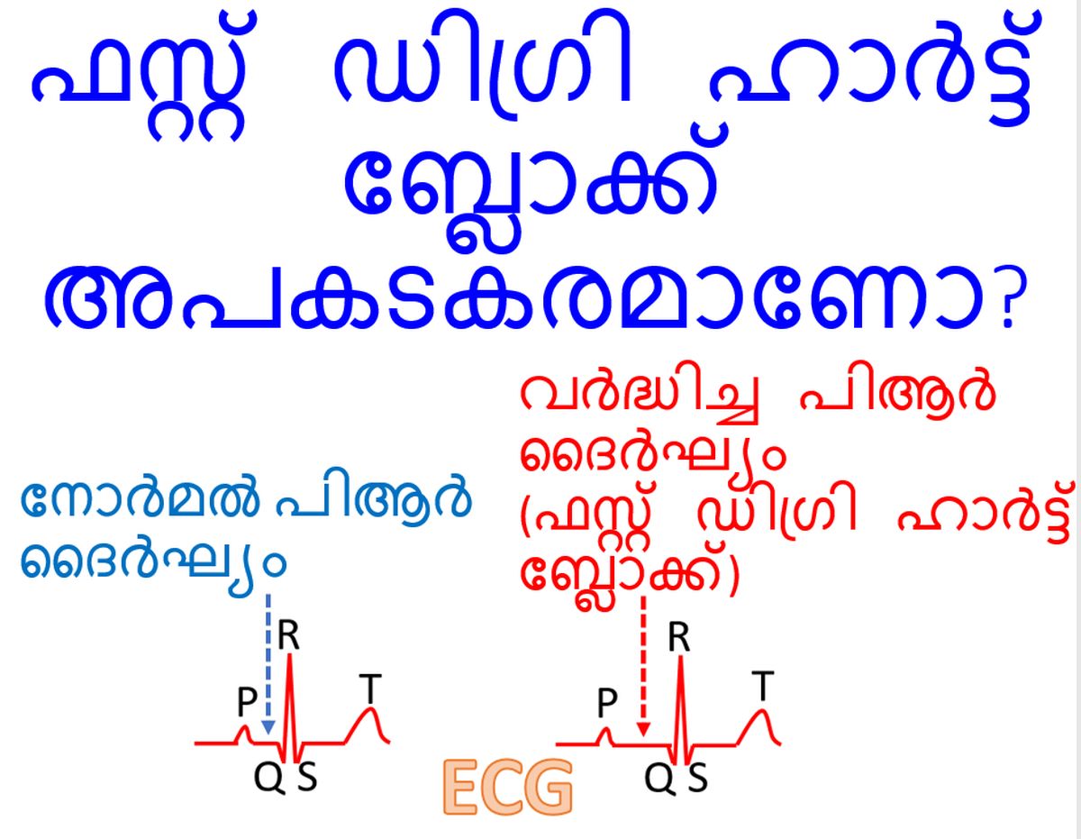 ഫസ്റ്റ് ഡിഗ്രി ഹാർട്ട് ബ്ലോക്ക് അപകടകരമാണോ