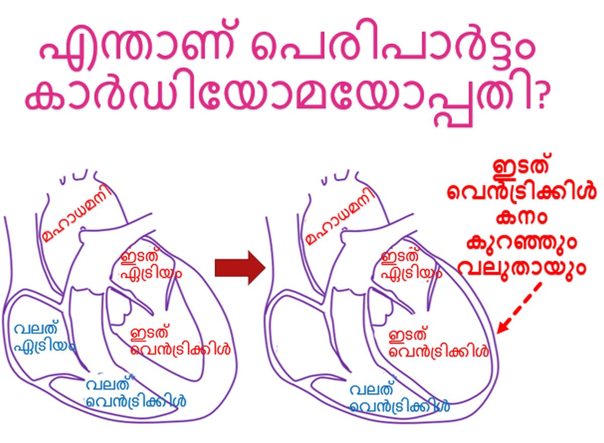 എന്താണ് പെരിപാർട്ടം കാർഡിയോമയോപ്പതി