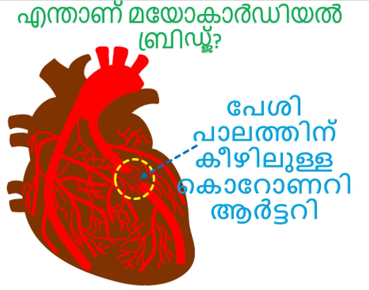 എന്താണ് മയോകാർഡിയൽ ബ്രിഡ്ജ്