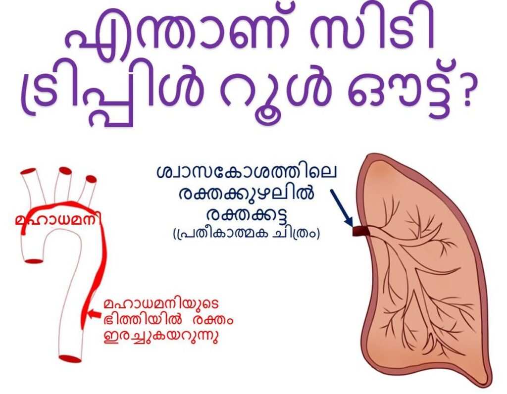 എന്താണ് സിടി ട്രിപ്പിൾ റൂൾ ഔട്ട്